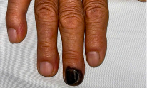 Detecting cancer from a dark brown mark on the fingernail