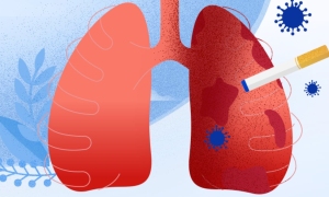 Lung cancer risk after quitting smoking