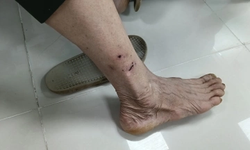Families "force" elderly parents to get rabies vaccinations