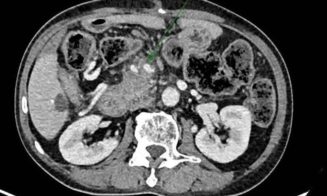 Successful biopsy of pancreatic tumor in a challenging location