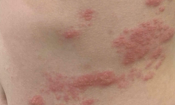 13-year-old boy diagnosed with shingles