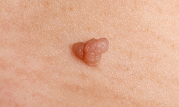 Genital bumps: genital warts or pearly papules?