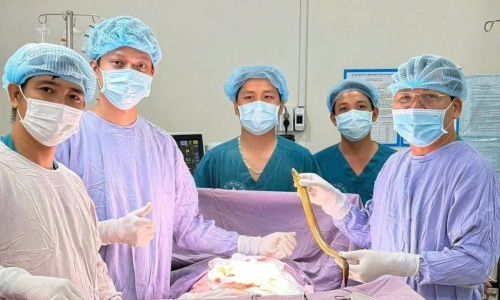 Surgery removes 50 cm eel that pierced man's rectum