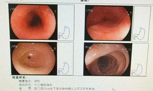 Woman develops 8 cm esophageal ulcer from quickly swallowing hotpot food