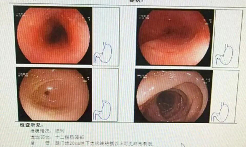 Woman develops 8 cm esophageal ulcer from quickly swallowing hotpot food