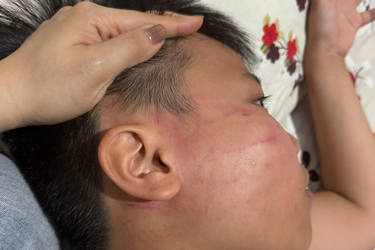 Boy suffers facial bruising, ear ringing after tutoring with foreign teacher