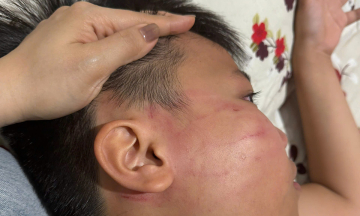 Boy suffers facial bruising, ear ringing after tutoring with foreign teacher