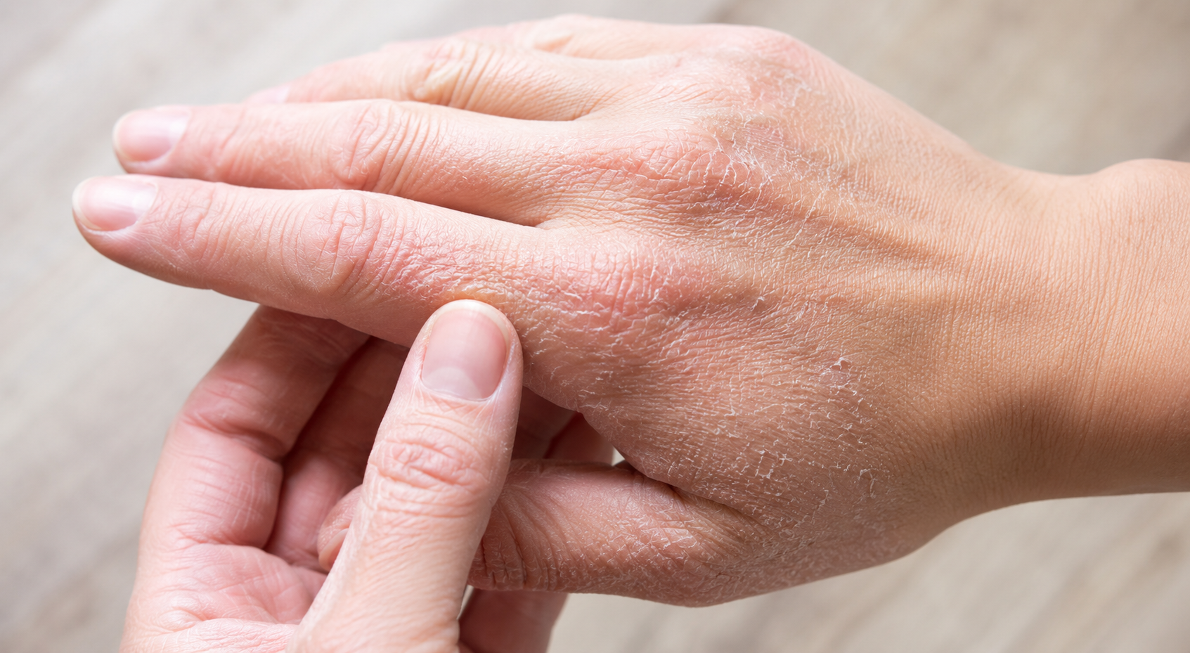 Skin signs can signal vitamin deficiency