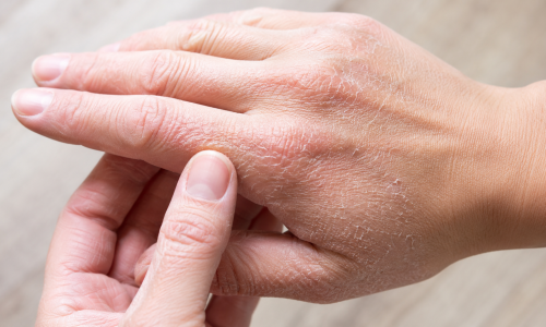 Skin signs can signal vitamin deficiency