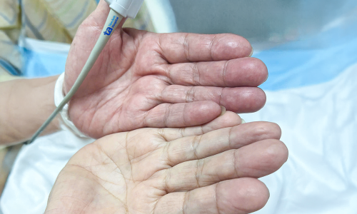 Blood clot causes arm artery blockage due to discontinued atrial fibrillation medication