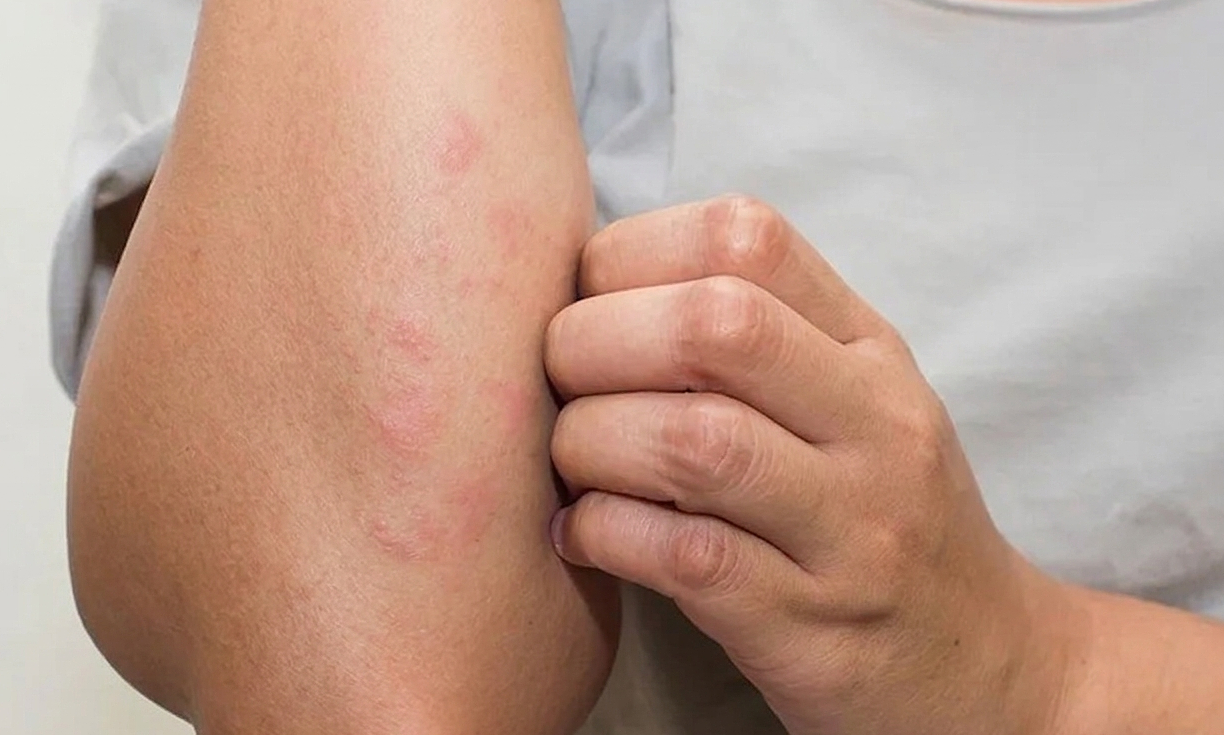 Skin itching may warn of kidney failure