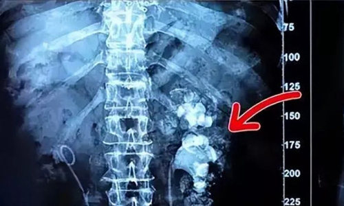Woman's kidneys riddled with stones after 9 years of drinking bubble tea instead of water
