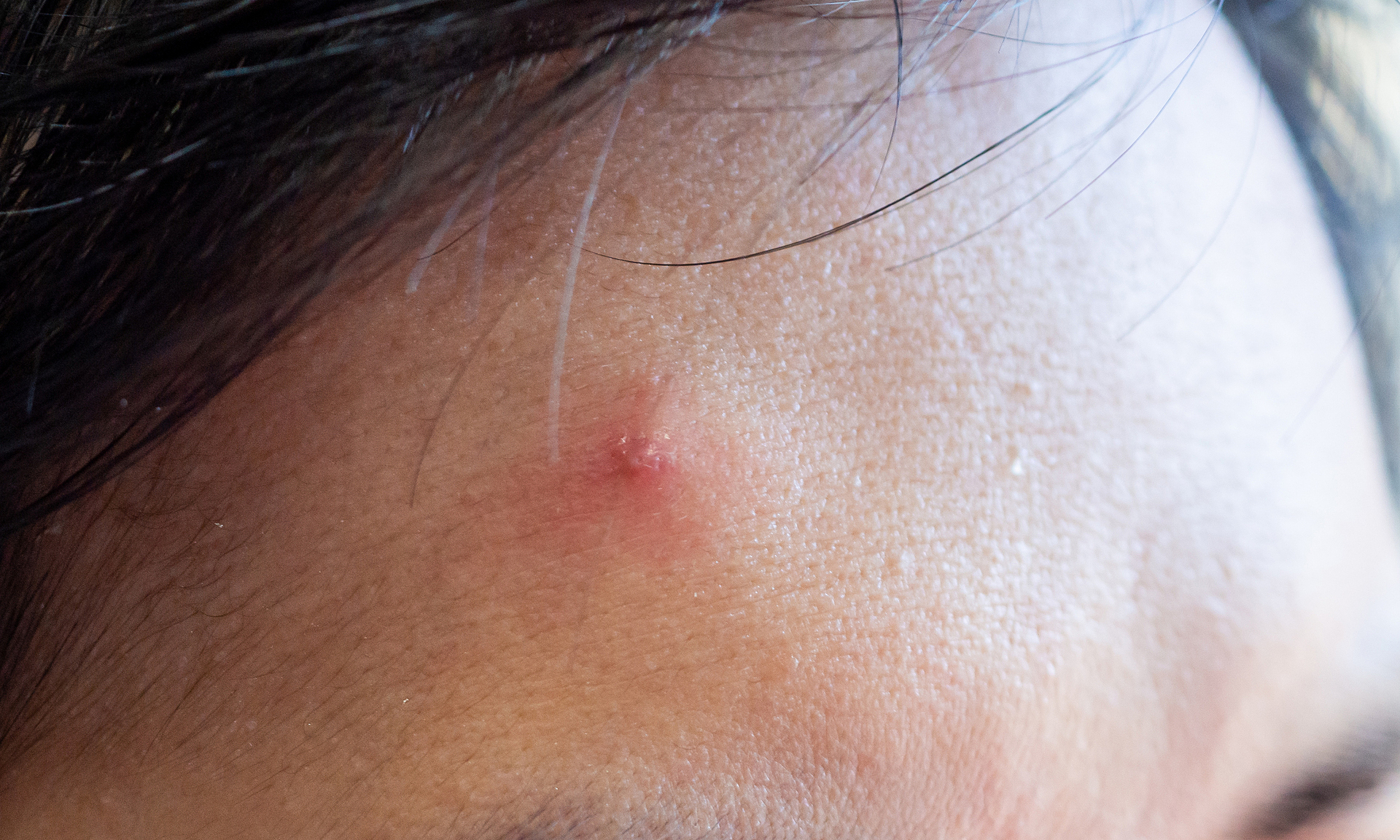 Genital warts on forehead, scalp: unusual cases highlight misdiagnosis risks
