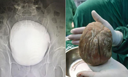 A 1.3 kg bladder stone causes a man three years of painful urination