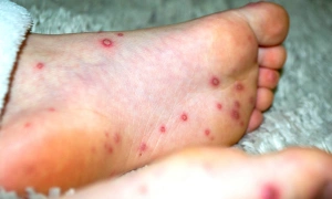 Are hand and foot blisters a sign of hand, foot, and mouth disease?