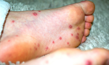 Are hand and foot blisters a sign of hand, foot, and mouth disease?
