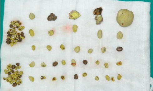 Doctor shares dietary tips to prevent widespread kidney stones