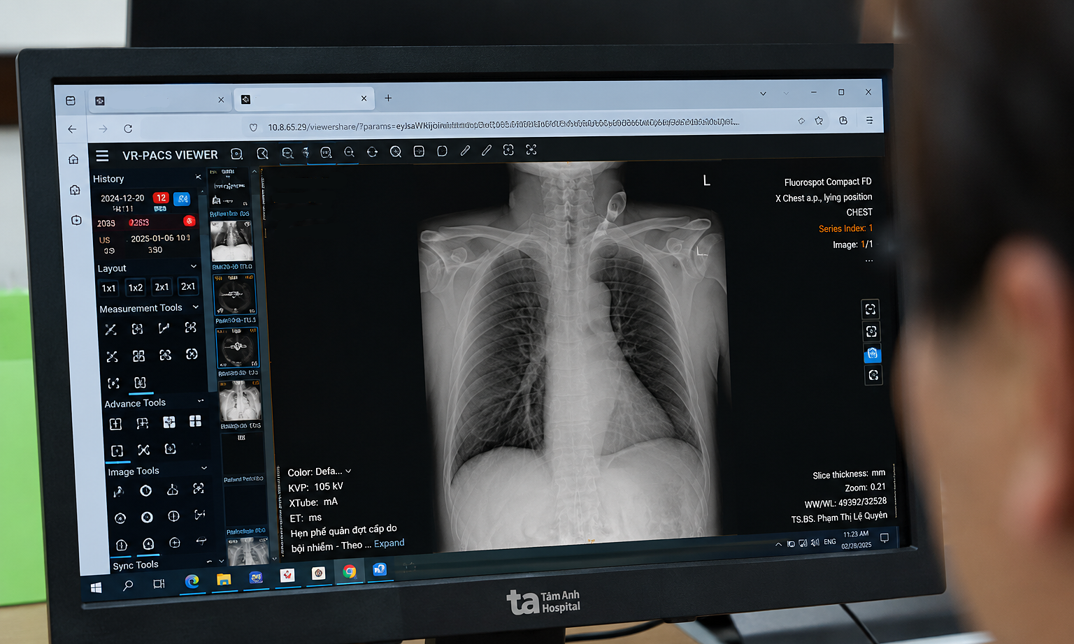 Mistaken for asthma, a 77-year-old's persistent symptoms reveal invasive lung fungus