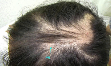 Young girl diagnosed with hair-pulling syndrome