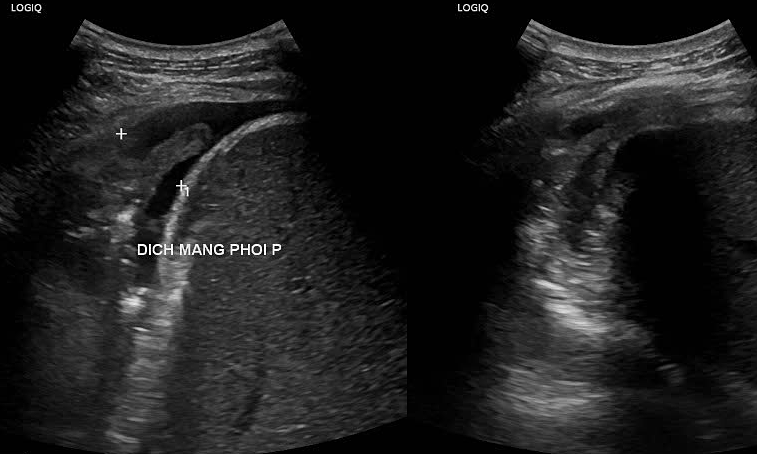 Lung damage from autoimmune myositis after fungal infection