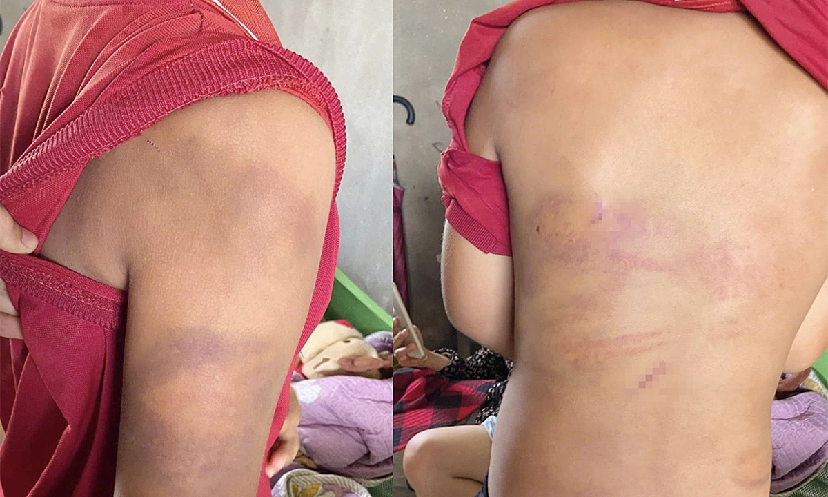 Police question father after son found bruised from bamboo stick beating