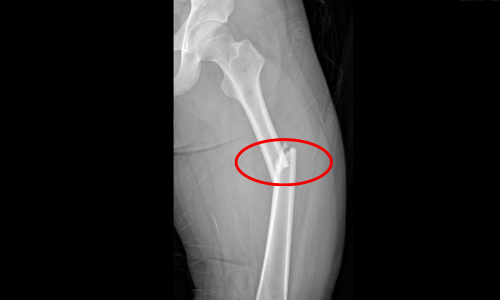 Male student suffers femur fracture before graduation exam