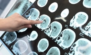 Should you take medication to prevent stroke?