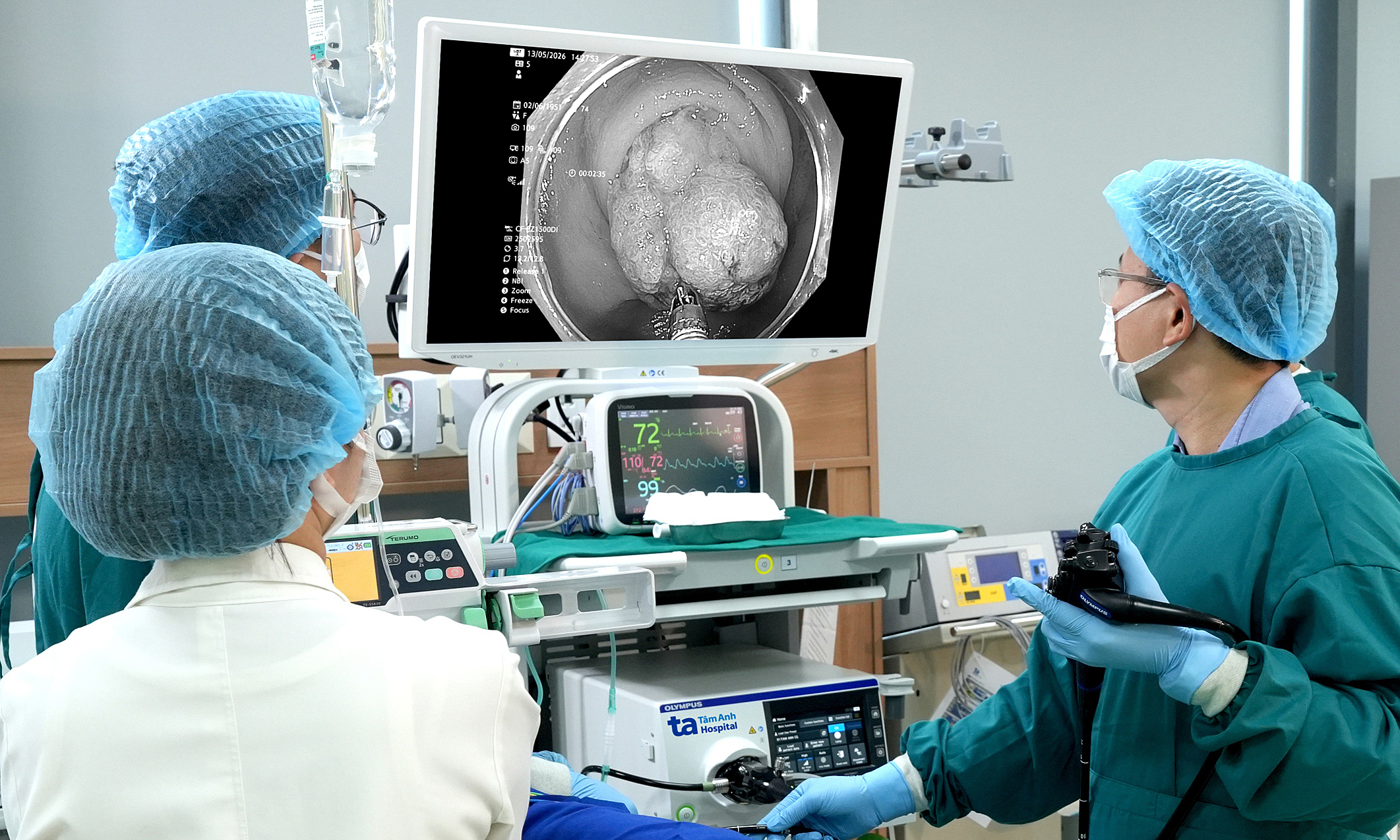 Endoscopic removal of appendix polyp with cancer risk