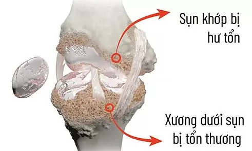 Why are knee joints susceptible to osteoarthritis?