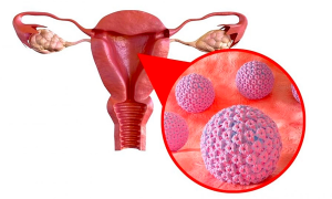 Doctor shares ways to identify cervical and ovarian cancer early