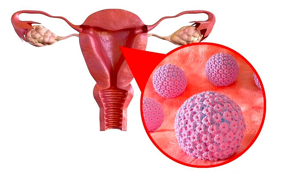 Doctor shares ways to identify cervical and ovarian cancer early