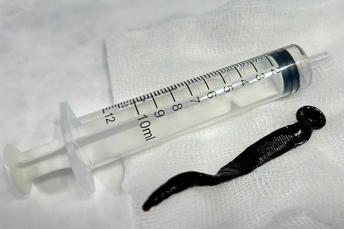 12 cm leech found alive in boy's airway