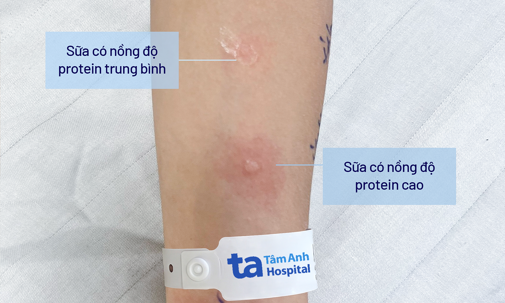 Young boy diagnosed with three allergic conditions