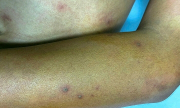 Teenager stung by over 50 hornets