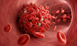 Where do blood clots causing stroke typically form?
