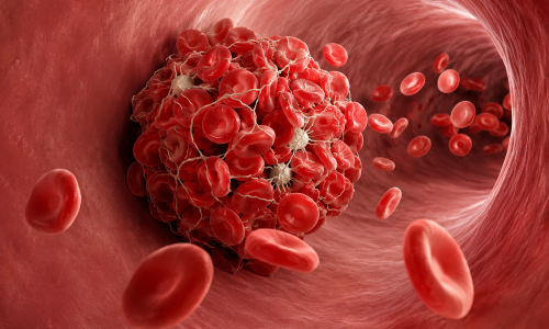 Where do blood clots causing stroke typically form?