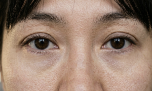 Causes of dark circles under the eyes