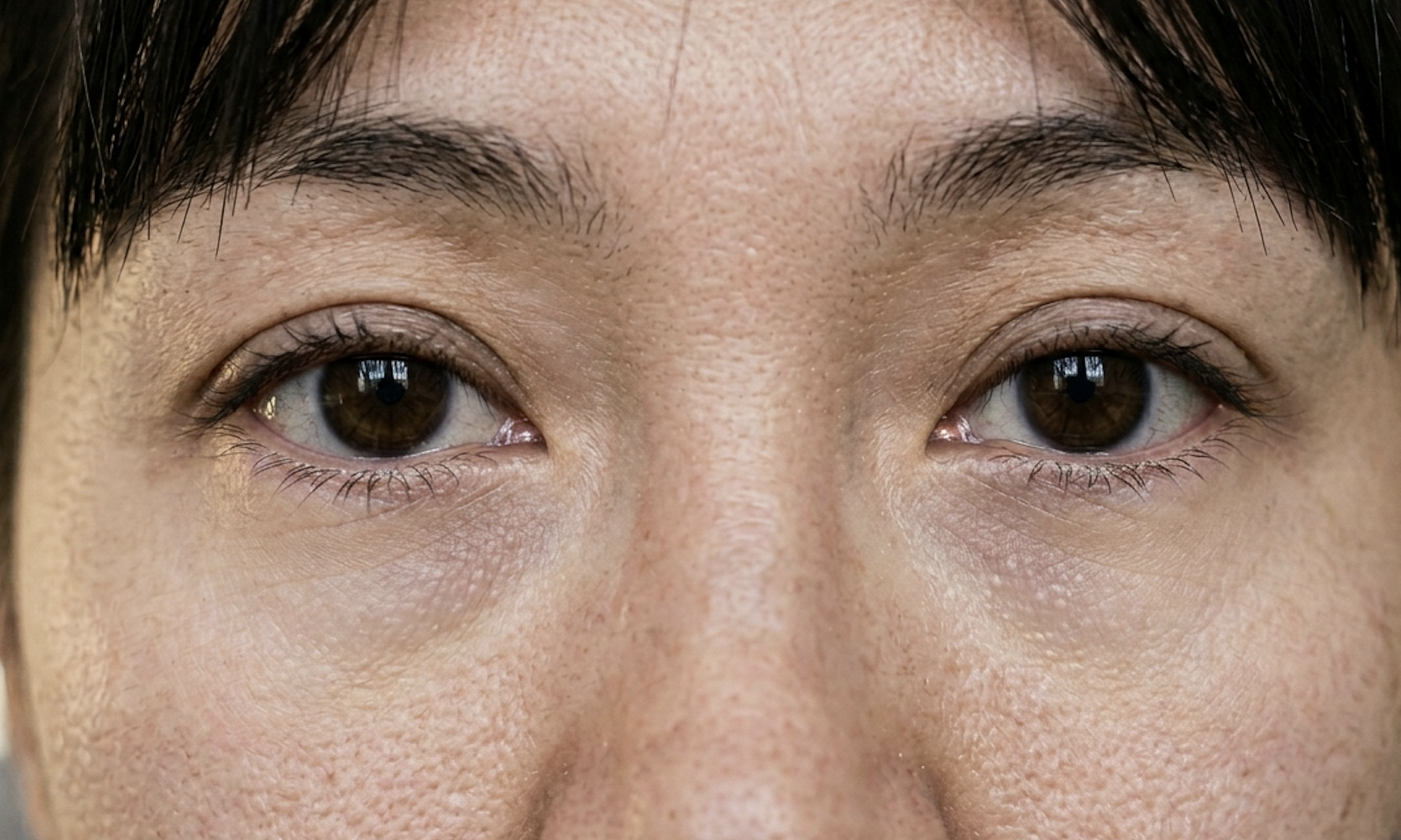 Causes of dark circles under the eyes