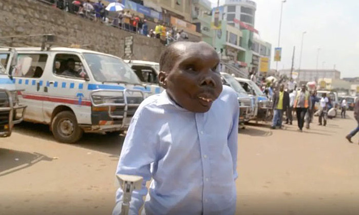Man with rare disease dubbed 'stone man' shows resilience