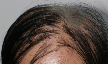 Woman loses hundreds of hairs daily due to rare, world-first dual dermatological condition