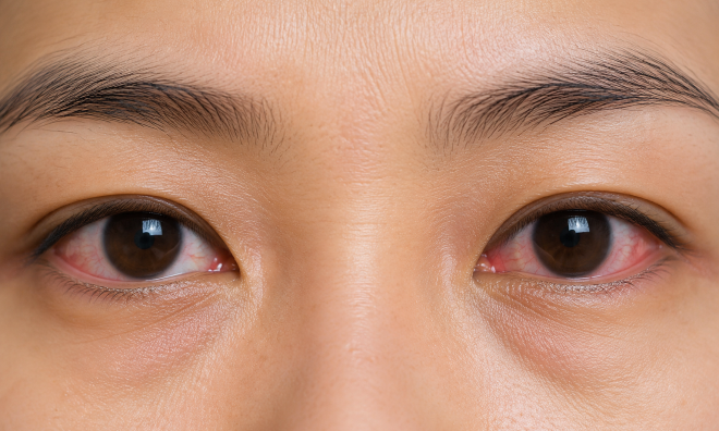 Unilateral drooping eyelid: what does it signal?