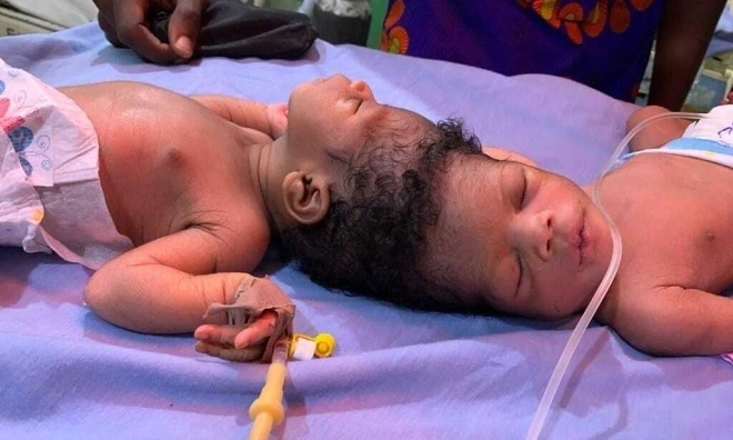 Conjoined twins successfully separated with AI assistance