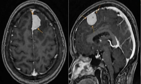 Brain tumor linked to chronic insomnia in woman