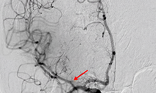 Blood clot in man's brain causes stroke