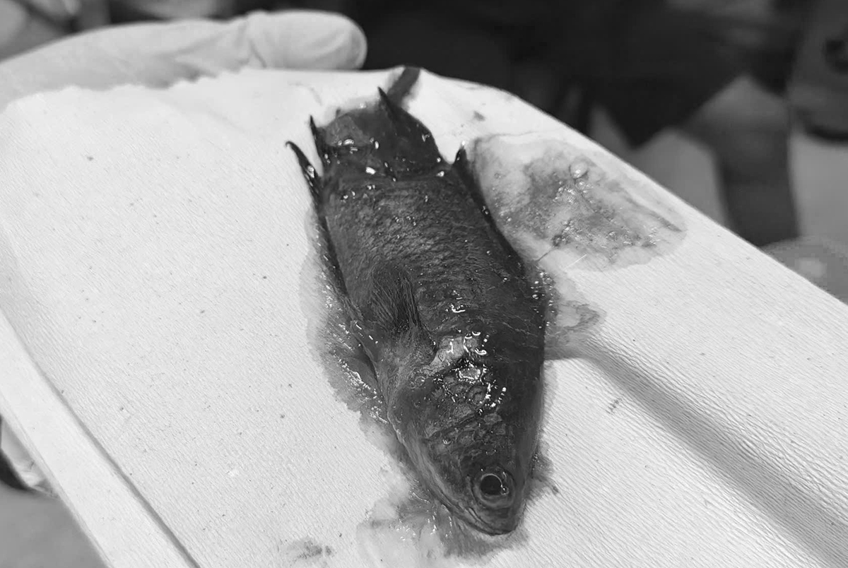 Live Anabas fish enters man's esophagus