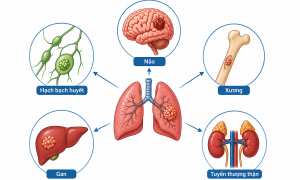 Where can lung cancer metastasize?