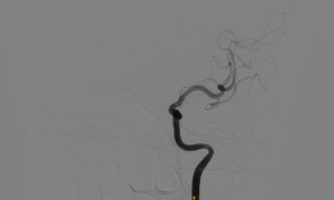 Stroke after ball impact to neck