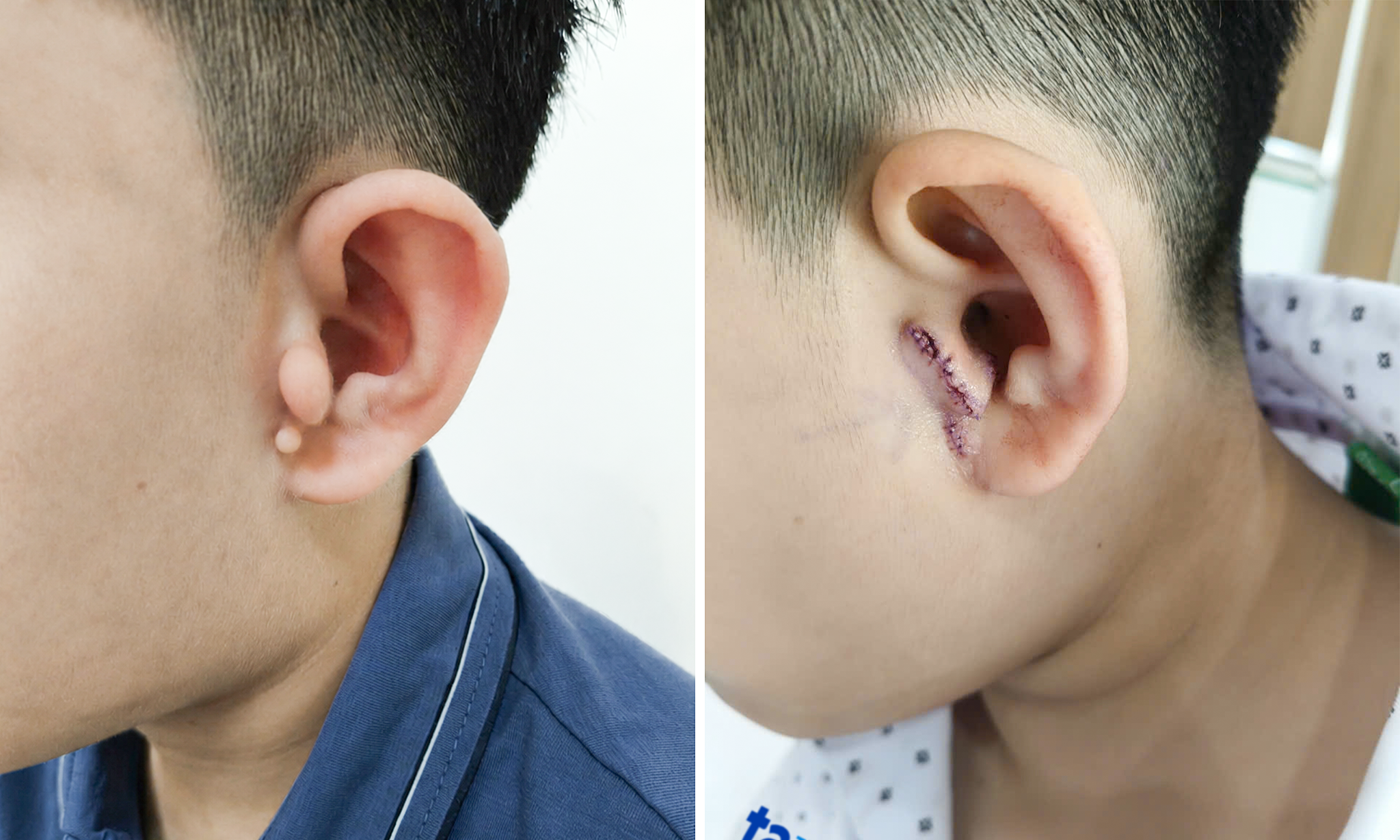 Boy born with congenital ear deformity