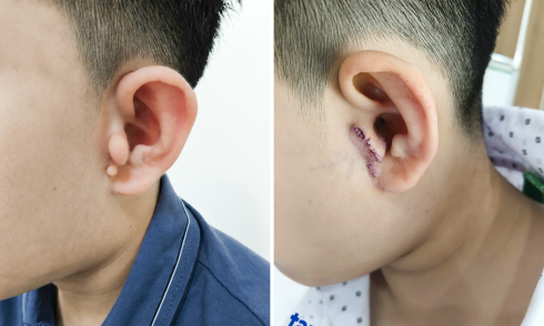Boy born with congenital ear deformity