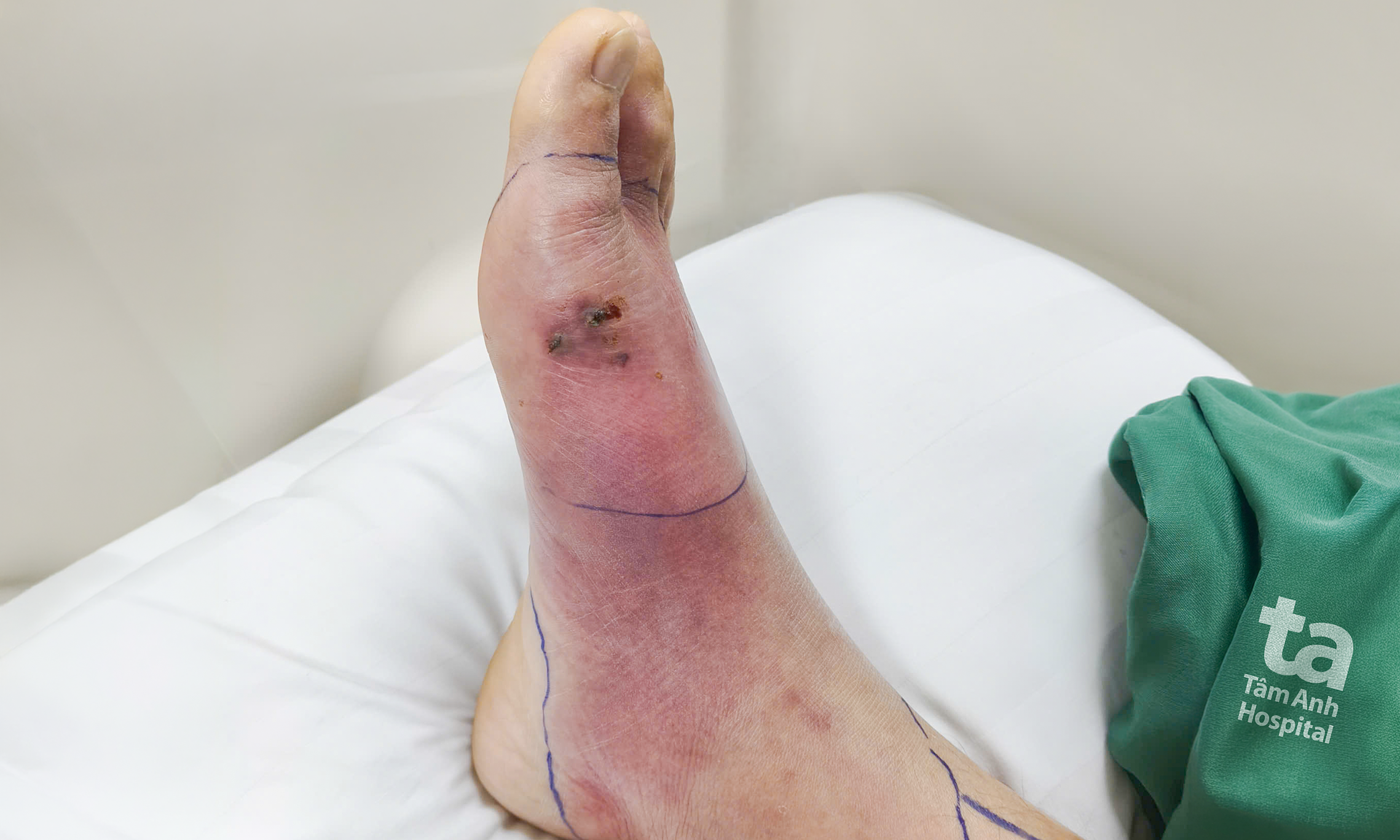 Streptococcal infection from a small foot wound